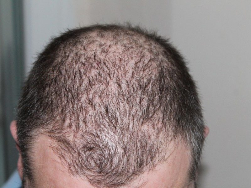 PRP contre la perte de cheveux : Ce que vous devez savoir sur les traitements